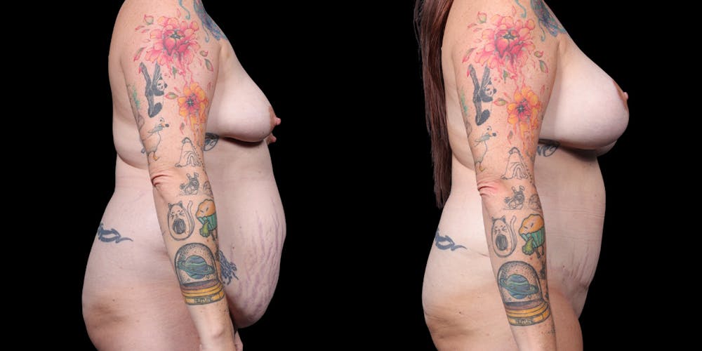 Mommy Makeover Before & After Gallery - Patient 505043 - Image 3