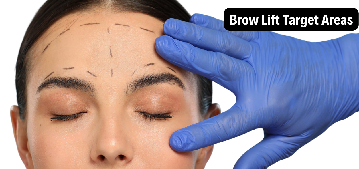 Brow lift target areas illustrated on a patient with surgical markings on the forehead while a surgeon adjusts the brow region. Visual guide showing where cosmetic brow lift incisions and tissue lifting are performed to smooth forehead wrinkles and raise sagging brows. Close-up of a woman with surgical marking lines on her forehead and brows, eyes closed, as a surgeon wearing blue medical gloves demonstrates brow lift target areas for cosmetic forehead lifting.