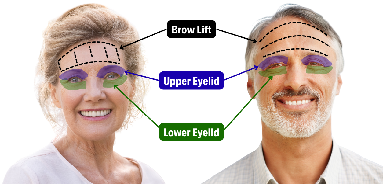 Side-by-side image of a woman and man with color-coded markings showing brow lift, upper eyelid surgery, and lower eyelid surgery target areas on the forehead and around the eyes, illustrating how each cosmetic procedure addresses different parts of the face.