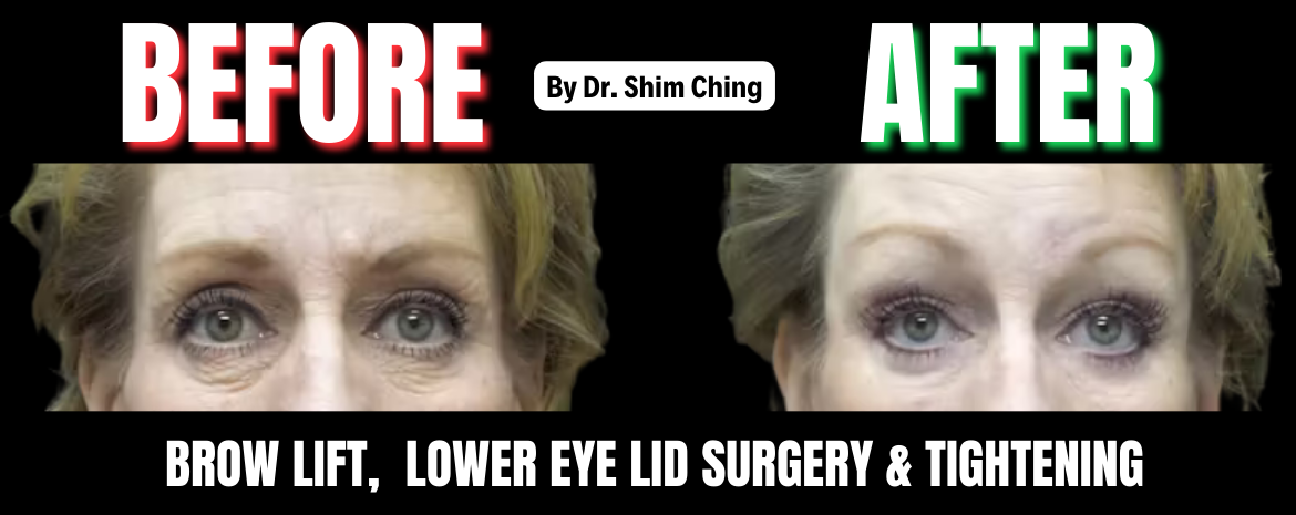 Before and after brow lift and eyelid surgery photo of a middle-aged woman showing dramatic improvement in sagging upper eyelids, puffy lower eyelids, and forehead drooping following brow lift, lower eyelid surgery, and skin tightening performed by Dr. Shim Ching. The left side shows heavy eye bags and hooded lids, while the right side reveals a smoother eye area, lifted brows, and refreshed appearance.