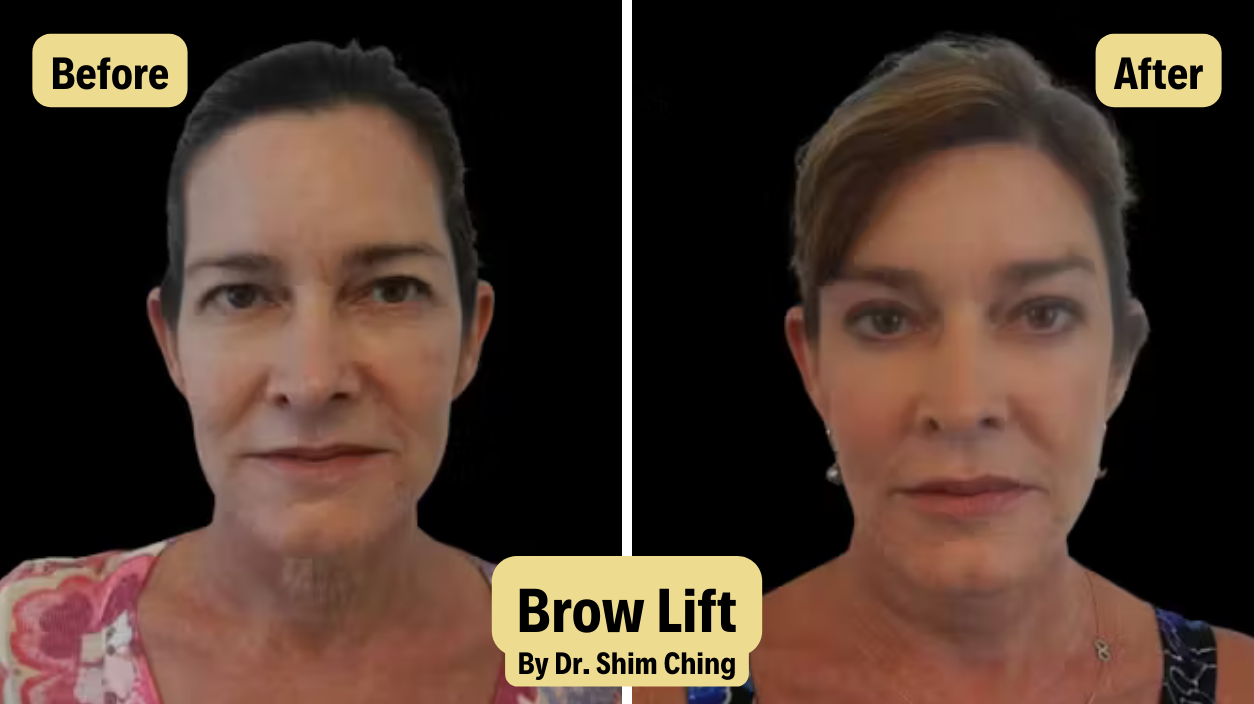Brow lift before and after results showing lifted brows, smoother forehead lines, and brighter eye appearance achieved by Dr. Shim Ching in Honolulu. Example of cosmetic brow lift surgery that rejuvenates the upper face and restores a more youthful expression. Before and after brow lift photo of a woman showing visible improvement in brow position, smoother forehead, and more open eyes after cosmetic brow lift performed by Dr. Shim Ching.