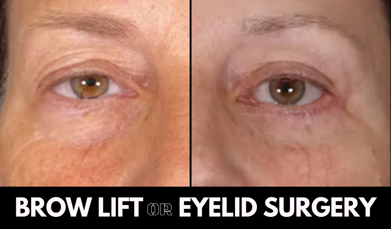 Shim Ching MD Blog | Brow Lift vs Blepharoplasty: Which One Fixes “Sagging Eyes”?