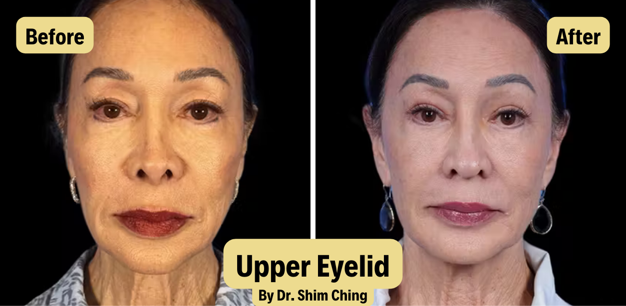 Before and after photo of a woman showing improvement in drooping upper eyelids and smoother eyelid contour after upper blepharoplasty performed by Dr. Shim Ching.