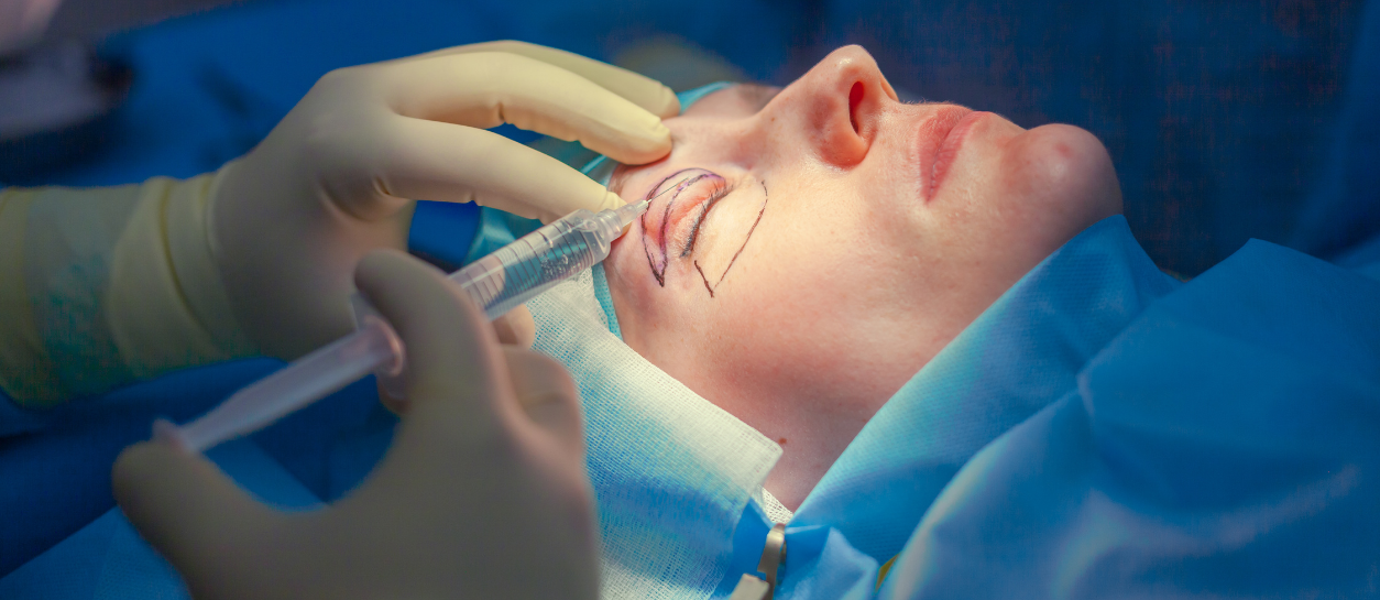 Surgeon injecting local anesthesia into an upper eyelid marked for blepharoplasty on a patient lying in the operating room, preparing the eye area for surgery.