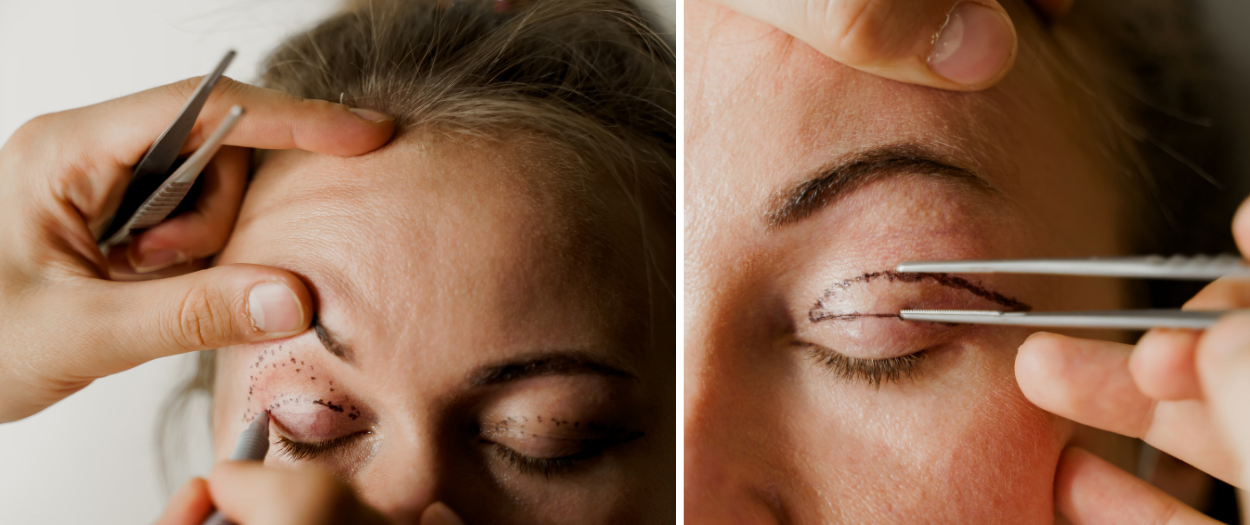 Close-up images of a patient with surgical markings being drawn on the upper eyelids before blepharoplasty, with a surgeon lifting the eyelid and preparing incision lines for eyelid surgery.