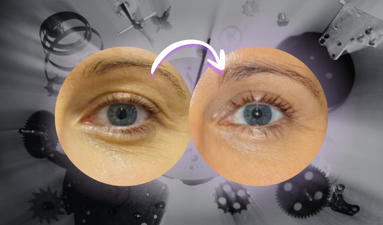 Shim Ching MD Blog | How Long Do Eyelid Surgery Results Last After Blepharoplasty