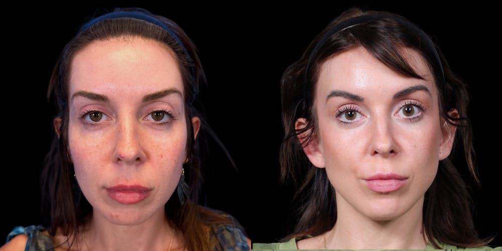 Facelift Before & After Gallery - Patient 376385 - Image 1