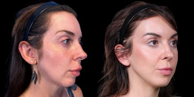 Facelift Before & After Gallery - Patient 376385 - Image 2