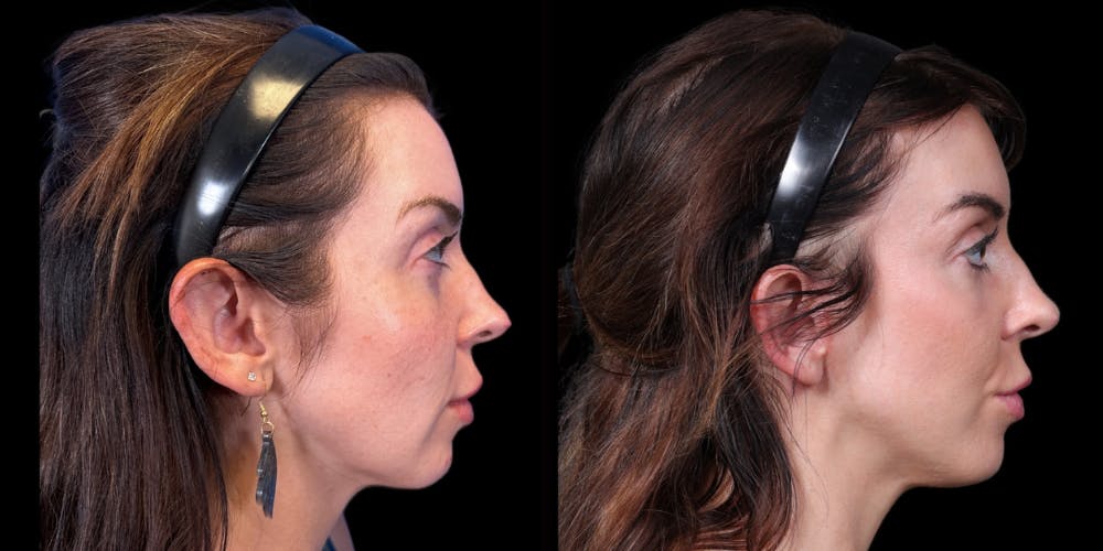 Facelift Before & After Gallery - Patient 376385 - Image 3