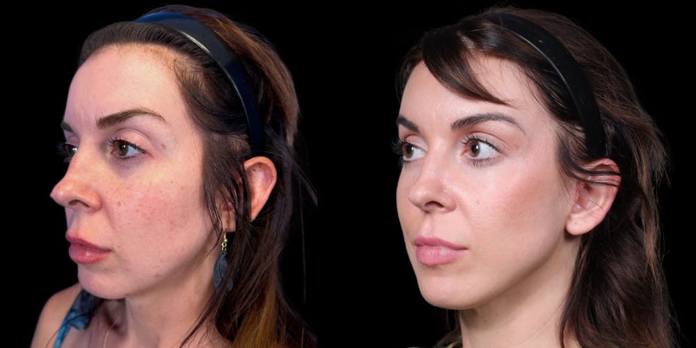 Facelift Before & After Gallery - Patient 376385 - Image 4