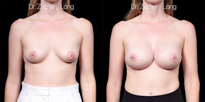 Breast Augmentation Before & After Gallery - Patient 165333 - Image 1