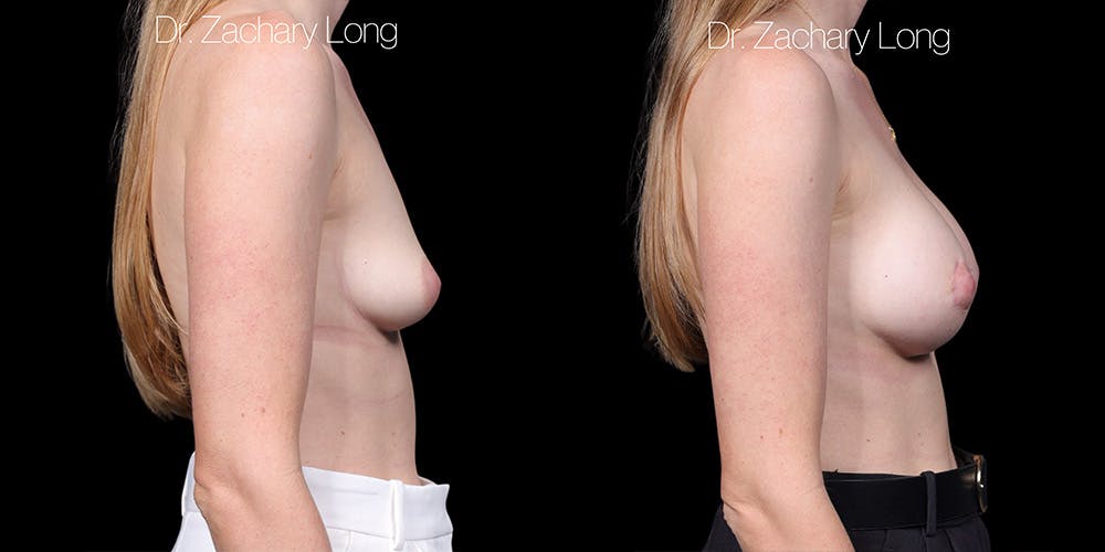 Breast Augmentation Before & After Gallery - Patient 165333 - Image 3