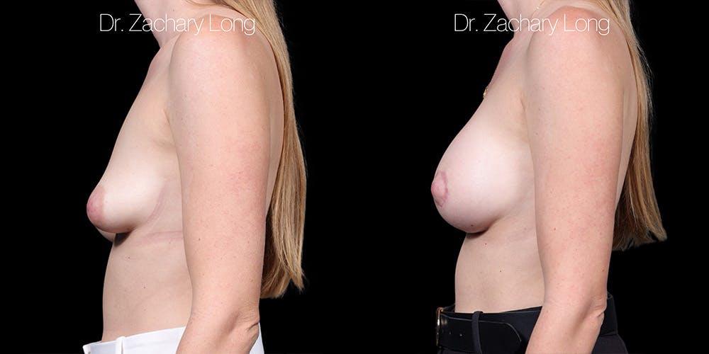 Breast Augmentation Before & After Gallery - Patient 165333 - Image 5