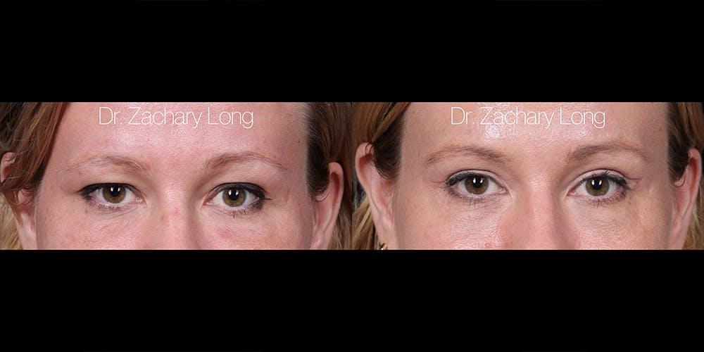 Eyelid Surgery Before & After Gallery - Patient 382131 - Image 1