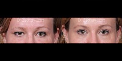 Eyelid Surgery Before & After Gallery - Patient 382131 - Image 1