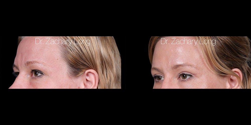 Eyelid Surgery Before & After Gallery - Patient 382131 - Image 4