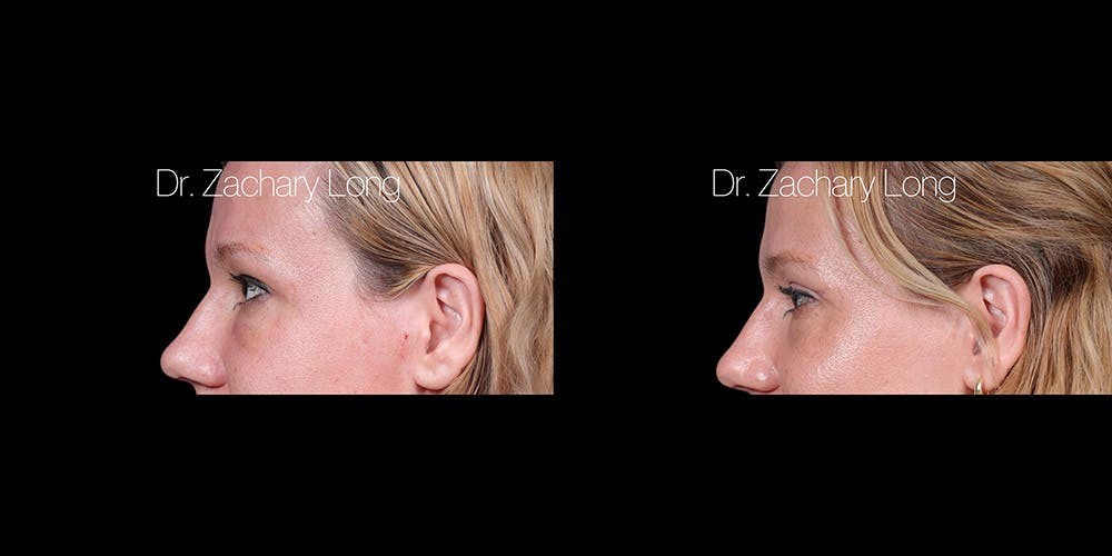 Eyelid Surgery Before & After Gallery - Patient 382131 - Image 5