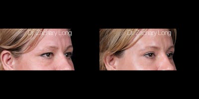Eyelid Surgery Before & After Gallery - Patient 382131 - Image 2
