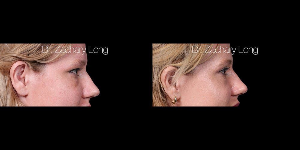 Eyelid Surgery Before & After Gallery - Patient 382131 - Image 3