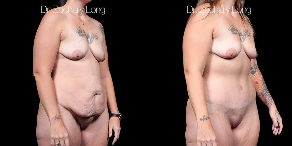Tummy Tuck Before & After Gallery - Patient 829954 - Image 1