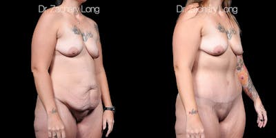 Tummy Tuck Before & After Gallery - Patient 829954 - Image 1