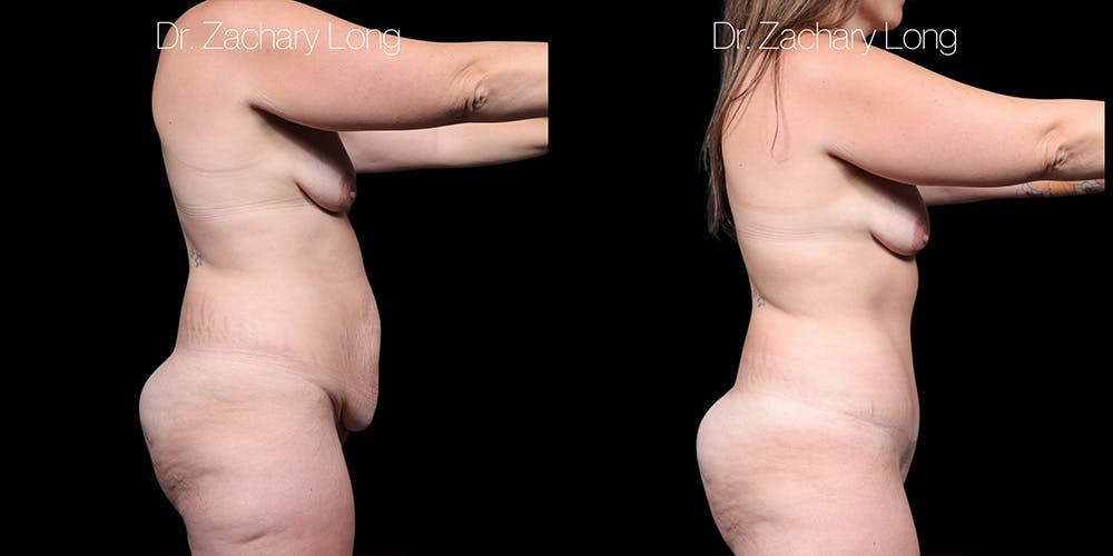 Tummy Tuck Before & After Gallery - Patient 829954 - Image 3