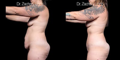 Tummy Tuck Before & After Gallery - Patient 829954 - Image 4