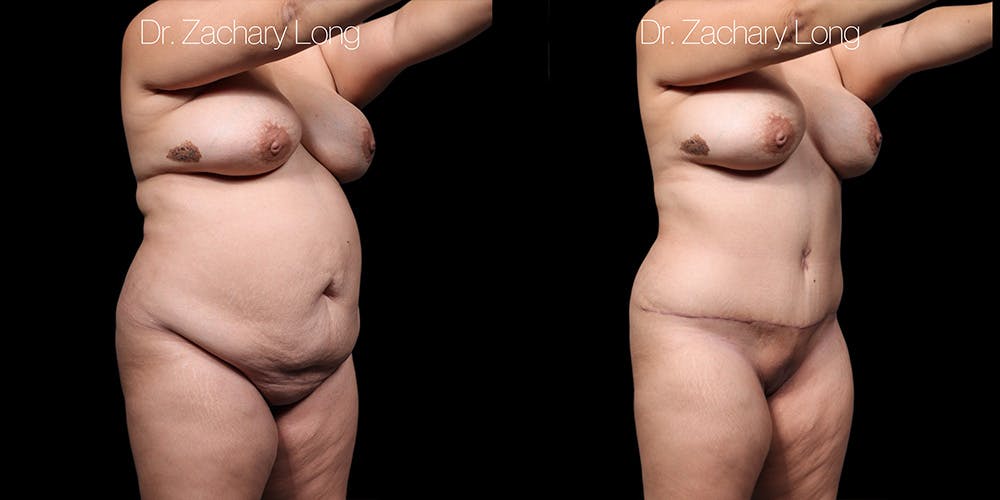 Tummy Tuck Before & After Gallery - Patient 318702 - Image 2