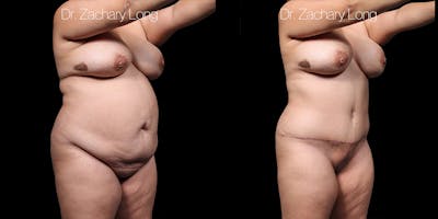 Tummy Tuck Before & After Gallery - Patient 318702 - Image 2