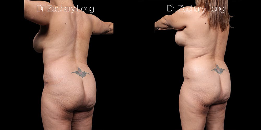 Tummy Tuck Before & After Gallery - Patient 318702 - Image 6