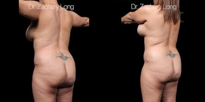 Tummy Tuck Before & After Gallery - Patient 318702 - Image 6