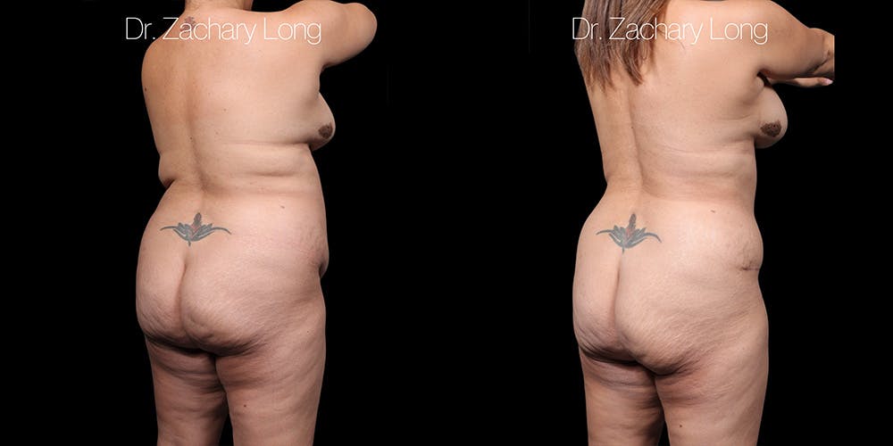 Tummy Tuck Before & After Gallery - Patient 318702 - Image 5