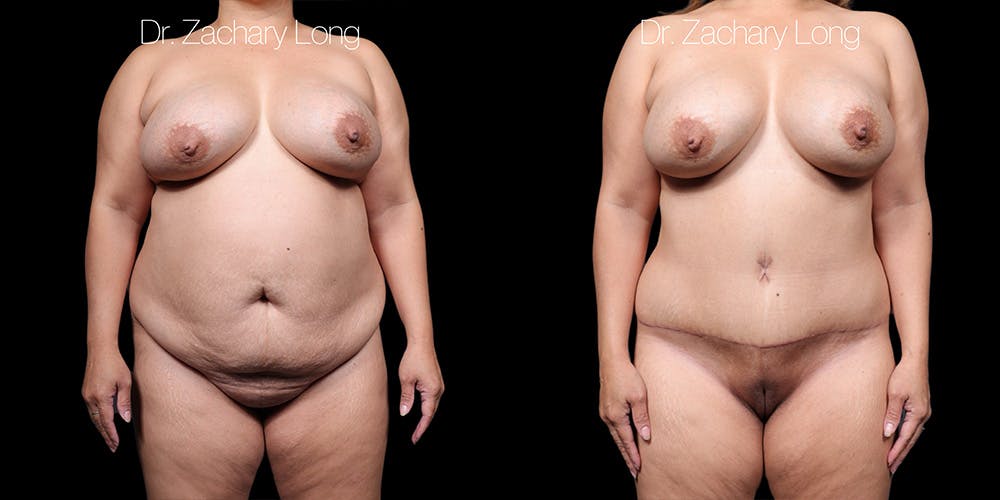 Tummy Tuck Before & After Gallery - Patient 318702 - Image 1