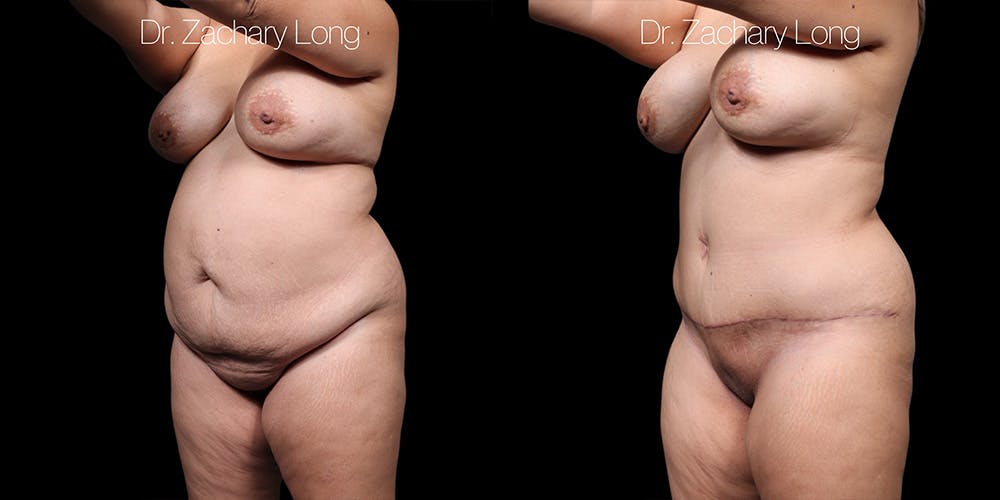 Tummy Tuck Before & After Gallery - Patient 318702 - Image 4