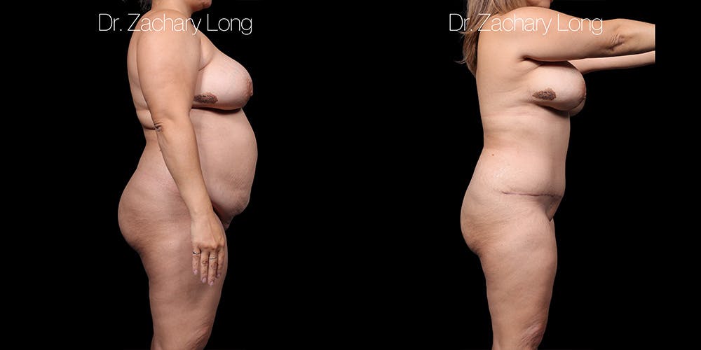 Tummy Tuck Before & After Gallery - Patient 318702 - Image 3
