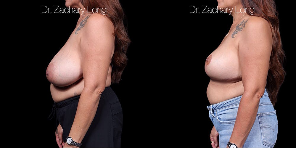 Breast Lift Before & After Gallery - Patient 374250 - Image 5