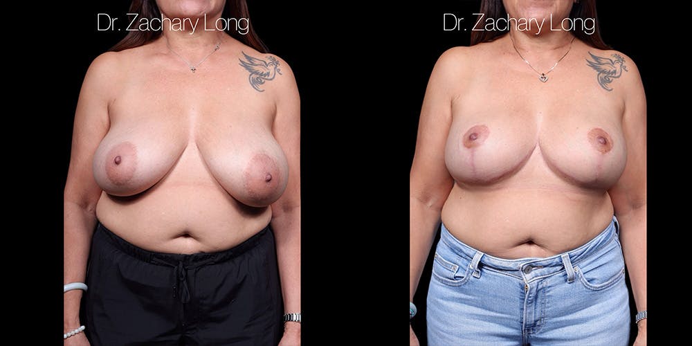 Breast Lift Before & After Gallery - Patient 374250 - Image 1