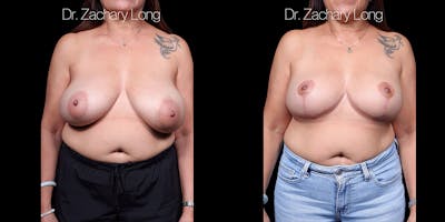 Breast Lift Before & After Gallery - Patient 374250 - Image 1