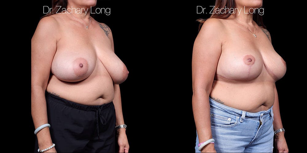 Breast Lift Before & After Gallery - Patient 374250 - Image 2
