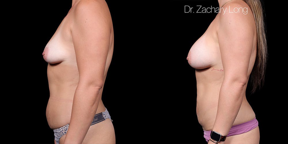 Breast Augmentation Before & After Gallery - Patient 320645 - Image 5