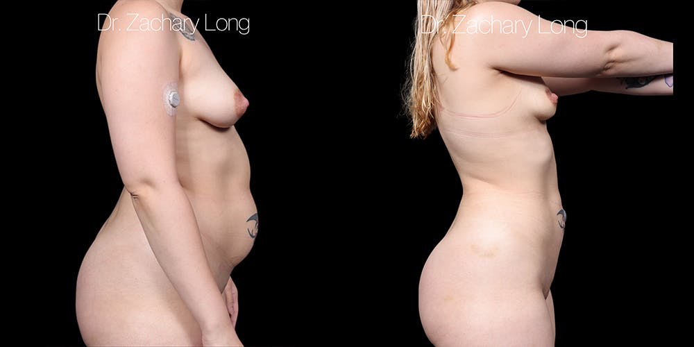Laser Liposuction Before & After Gallery - Patient 602639 - Image 3