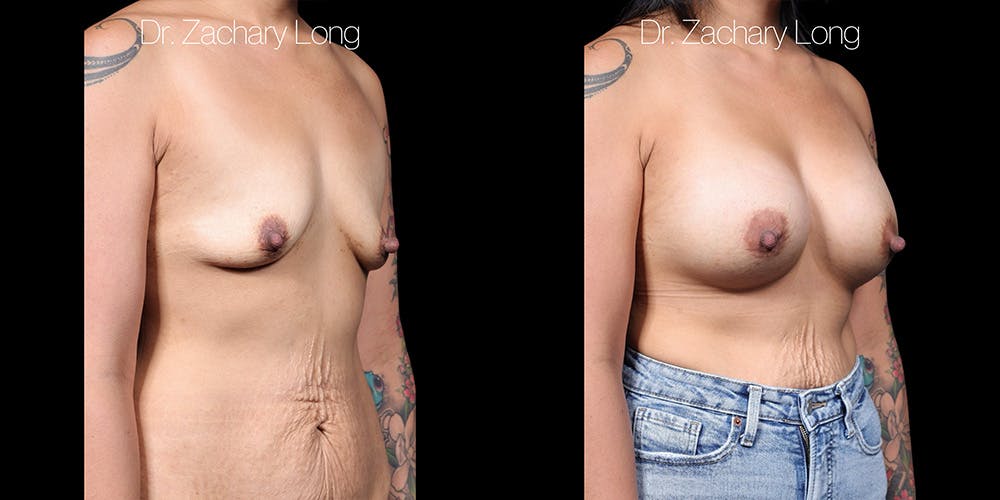 Breast Augmentation Before & After Gallery - Patient 118368 - Image 2
