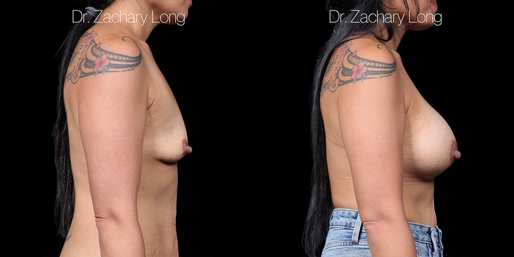 Breast Augmentation Before & After Gallery - Patient 118368 - Image 3