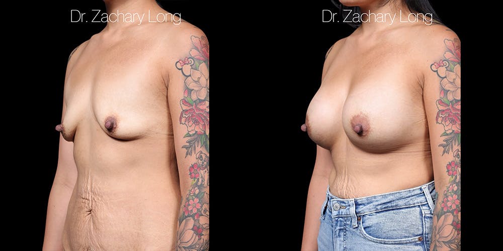 Breast Augmentation Before & After Gallery - Patient 118368 - Image 4