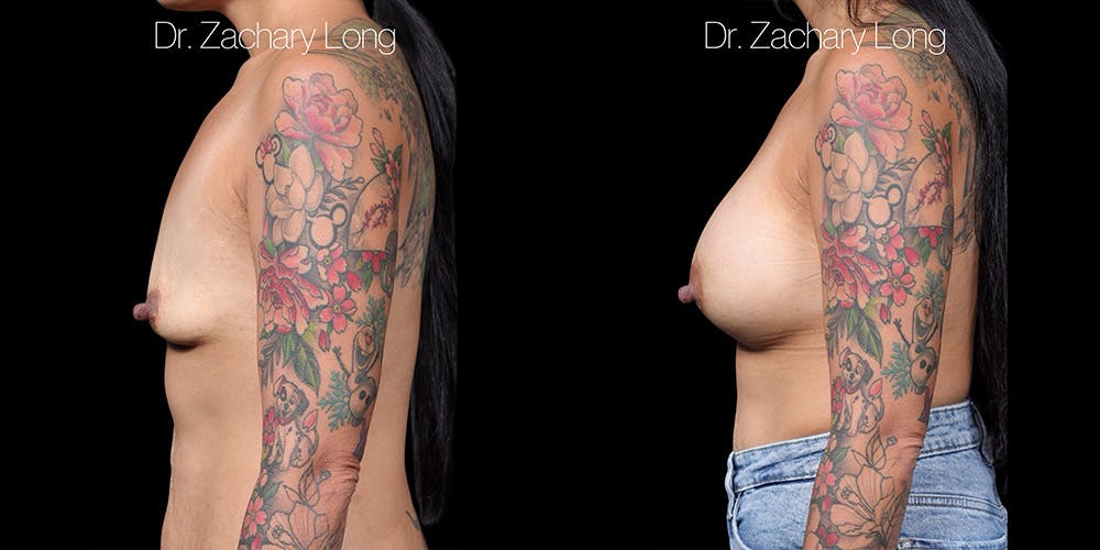 Breast Augmentation Before & After Gallery - Patient 118368 - Image 5