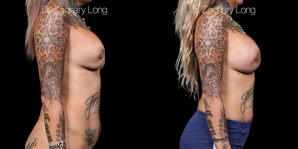Breast Augmentation Revision Before & After Gallery - Patient 407067 - Image 3