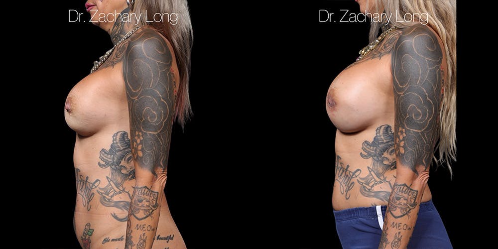 Breast Augmentation Revision Before & After Gallery - Patient 407067 - Image 5