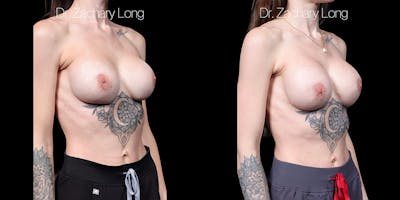 Breast Augmentation Revision Before & After Gallery - Patient 671019 - Image 2