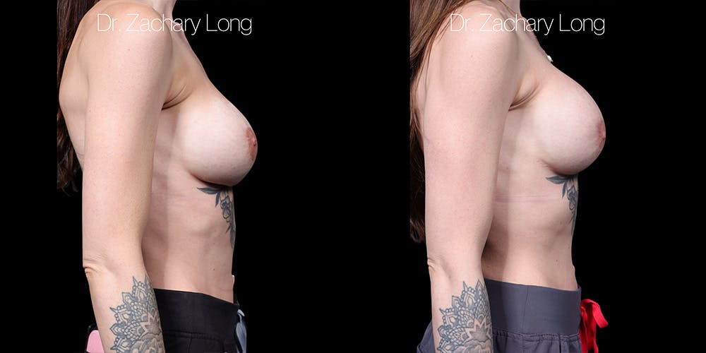 Breast Augmentation Revision Before & After Gallery - Patient 671019 - Image 3