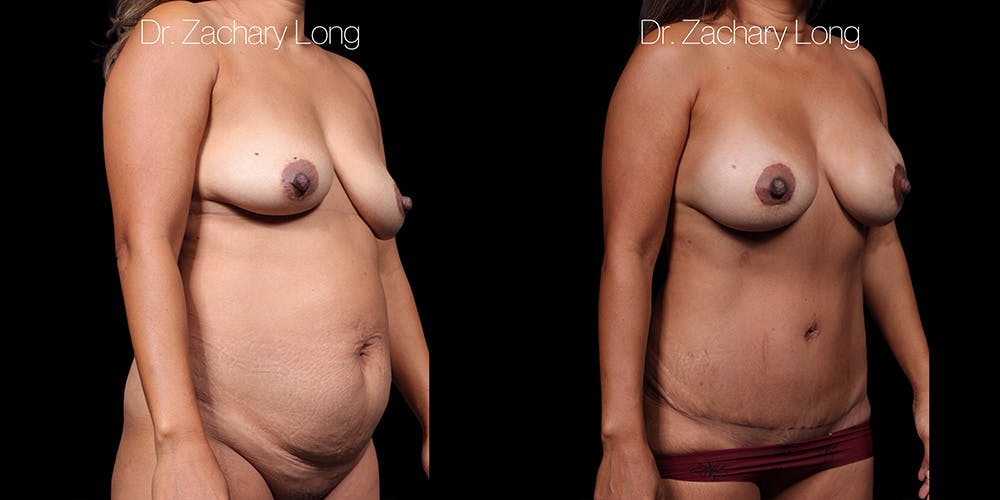 HiDefinition Liposuction Before & After Gallery - Patient 297161 - Image 2